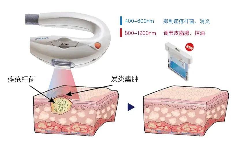 Acne痤疮滤光片 Acne痤疮滤光片