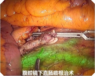 腹腔镜下直肠癌荧光成效