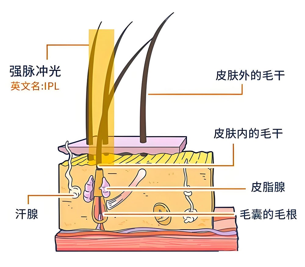光子脱毛